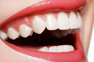 Cedar City teeth whitening